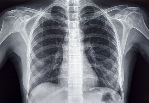 Chest X-Ray